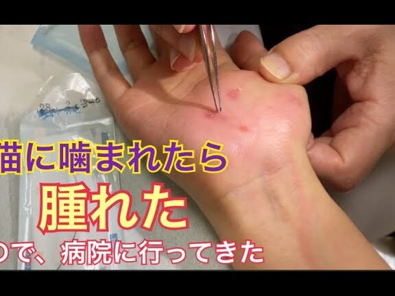 猫に噛まれると腫れる原因と対処法!病院へ行く目安は? 5 e78cabe381abe5999be381bee3828ce3828be381a8e885abe3828ce3828be58e9fe59ba0e381a8e5afbee587a6e6b395efbc81e79785e999a2e381b8e8a18ce3818f