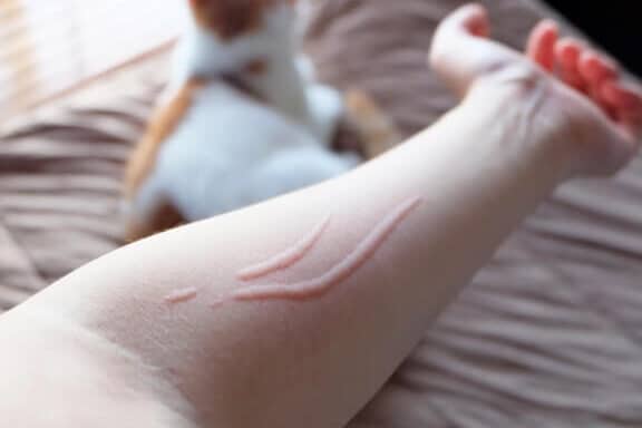 猫の噛み傷の治療法!消毒と薬、病院へ行く目安 5 e78cabe381aee5999be381bfe582b7e381aee6b2bbe79982e6b395efbc81e6b688e6af92e381a8e896ace38081e79785e999a2e381b8e8a18ce3818fe79baee5ae89